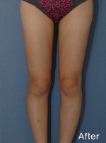 Liposuction