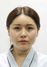 Rhinoplasty