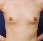 breast