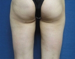 Liposuction