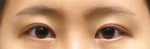 eye surgery