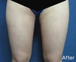 Liposuction