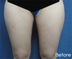Liposuction