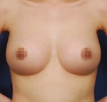breast