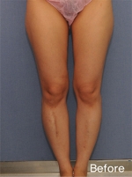 Liposuction