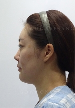 facial contouring
