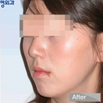 facial contouring