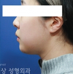 facial contouring