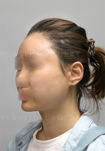 facial contouring
