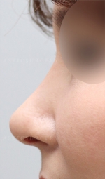 Rhinoplasty