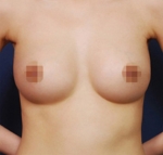 breast