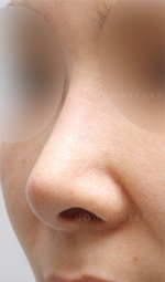 Rhinoplasty
