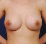 breast