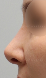 Rhinoplasty