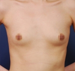 breast