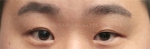 eye surgery