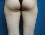Liposuction