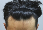 hairline