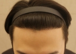 hairline