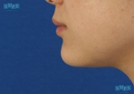 facial contouring