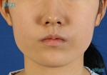 facial contouring
