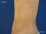 Liposuction
