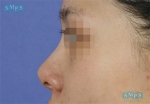 eye surgery