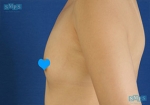 breast