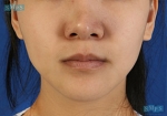 Rhinoplasty