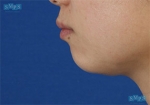 facial contouring