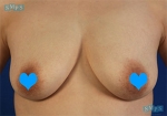 breast