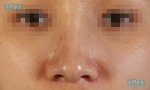 Rhinoplasty
