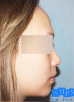 Rhinoplasty