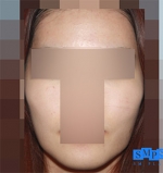 facial contouring