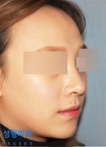 Rhinoplasty