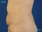 Liposuction
