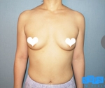 breast