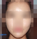 facial contouring
