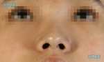 Rhinoplasty