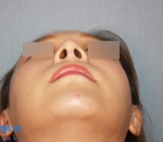 Rhinoplasty