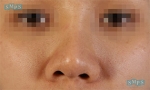 Rhinoplasty