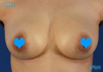 breast