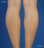 Liposuction