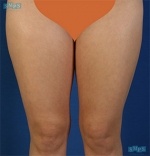 Liposuction