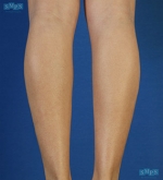 Liposuction