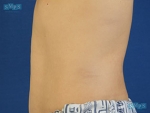 Liposuction