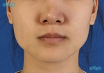 Rhinoplasty
