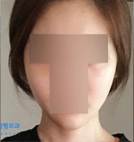 facial contouring