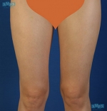Liposuction