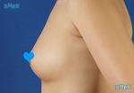 breast